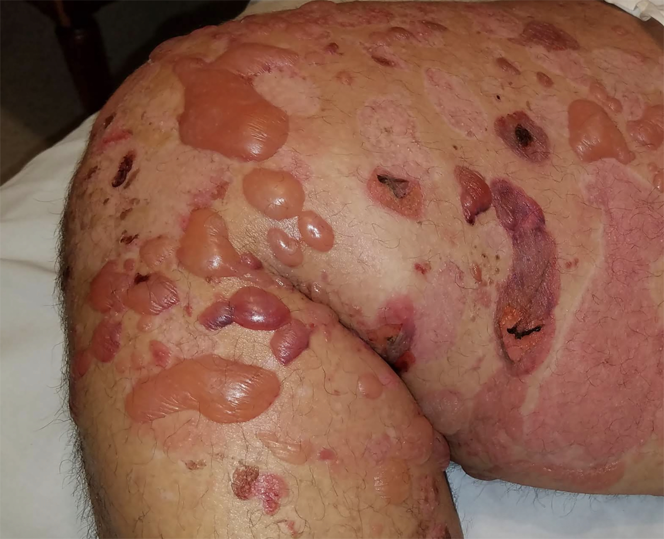 0 Enfermedades ampollares subepidérmicas autoinmunes