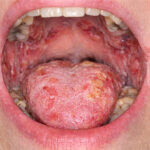 0 Pénfigo diagnóstico inmunológico