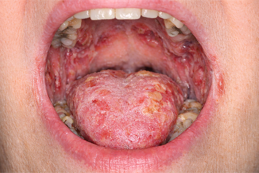 0 Pénfigo diagnóstico inmunológico