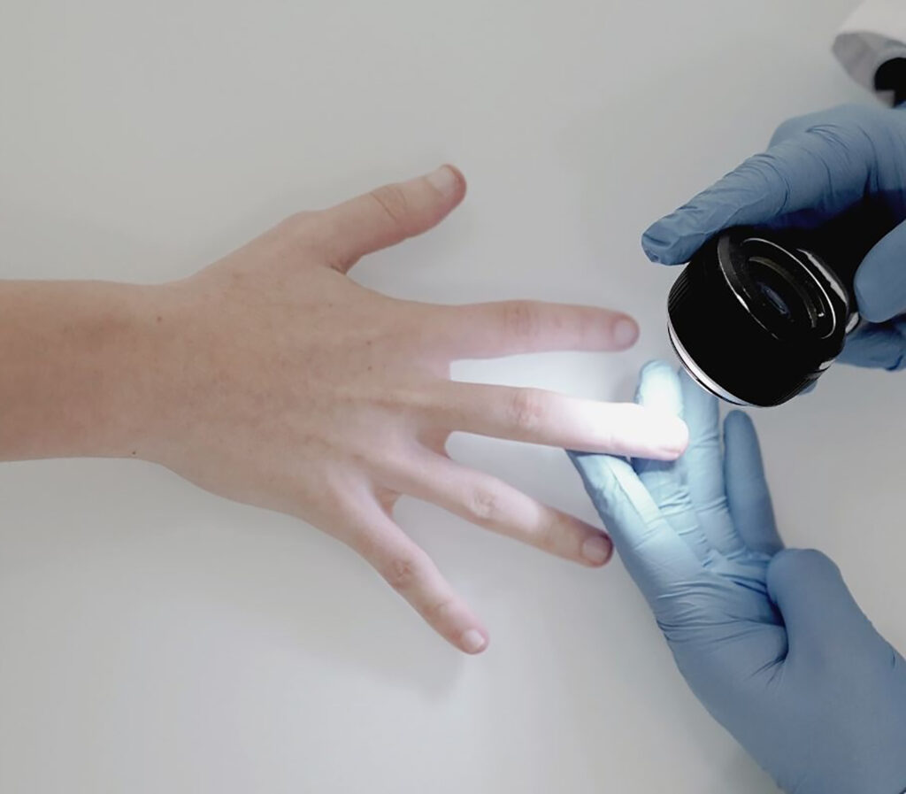 0 Uñas cáncer dermatoscopia