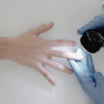 0 Uñas cáncer dermatoscopia