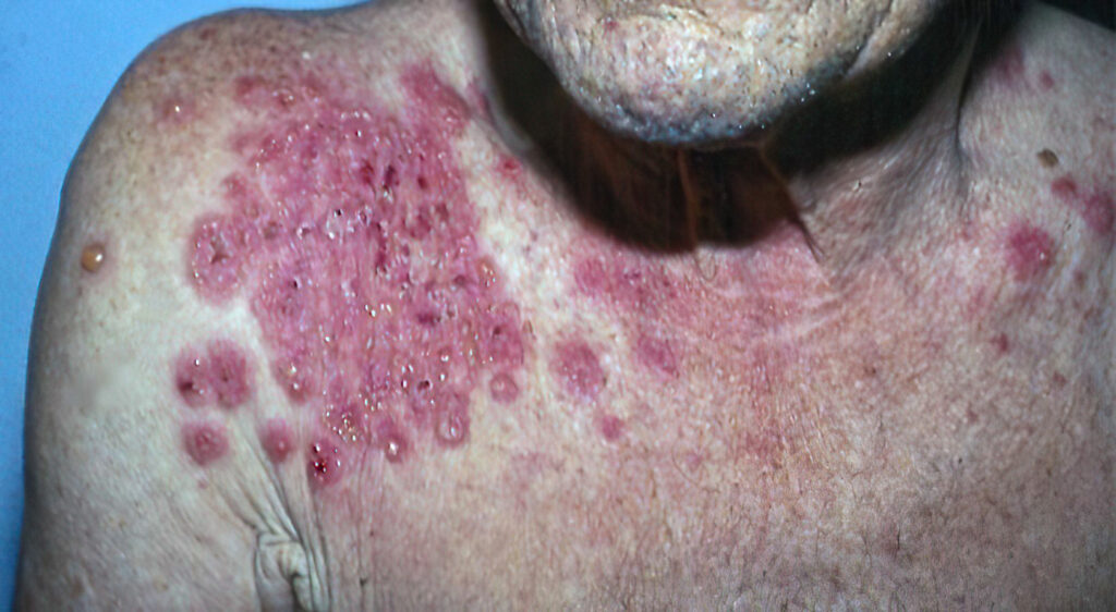 1 Diagnóstico enfermedades ampollares