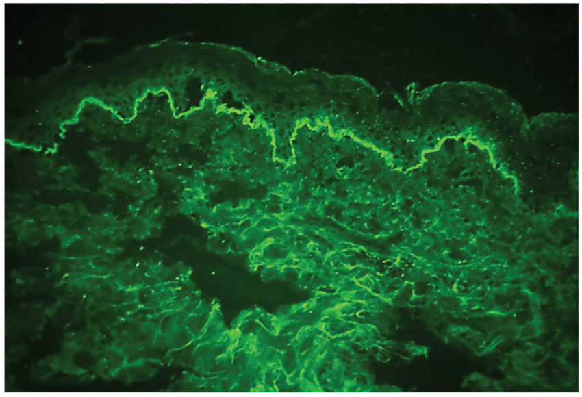 1 Inmunofluorescencia enfermedades ampollares.tif