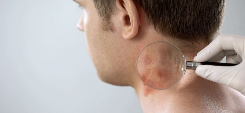 1 Psoriasis hipertensión mortalidad