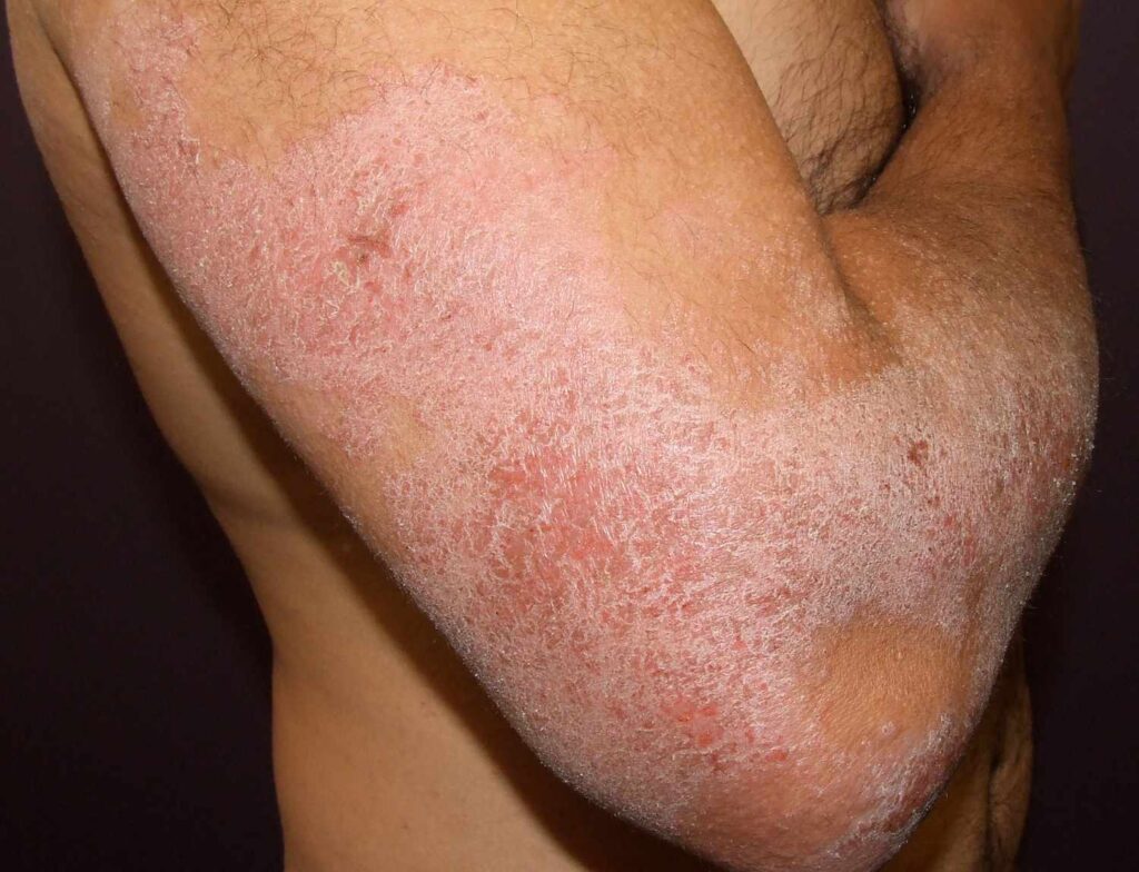 1 Psoriasis microbioma cutáneo
