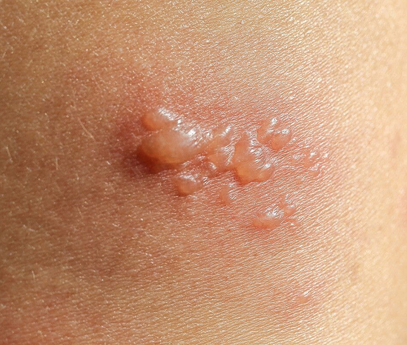 2 Autoanticuerpos enfermedades ampollares