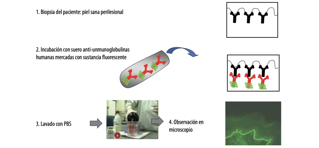 2 Enfermedades ampollares subepidérmicas autoinmunes