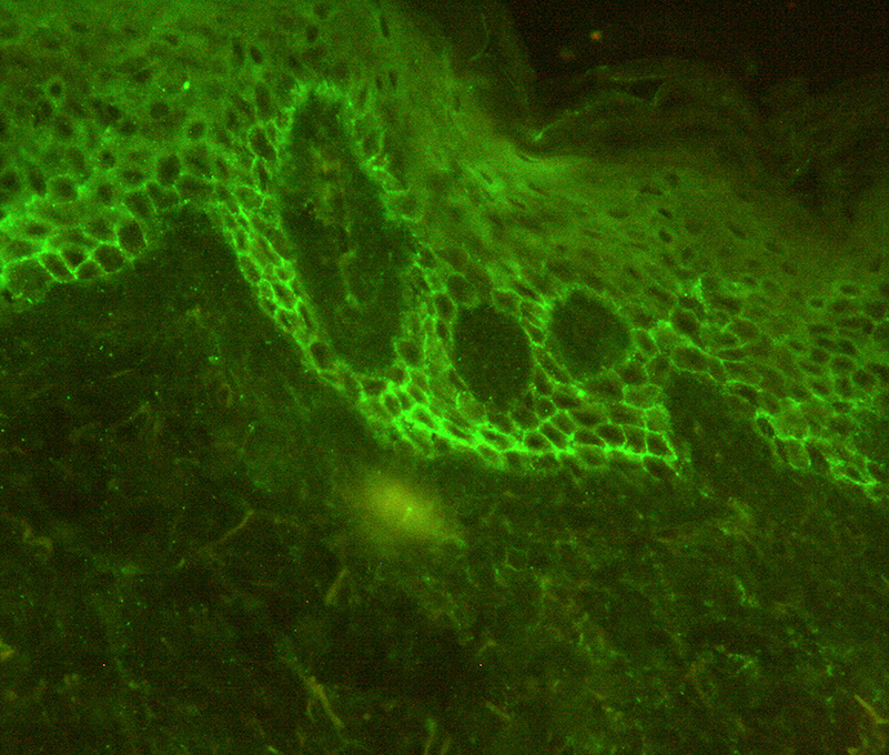 3 Autoanticuerpos enfermedades ampollares