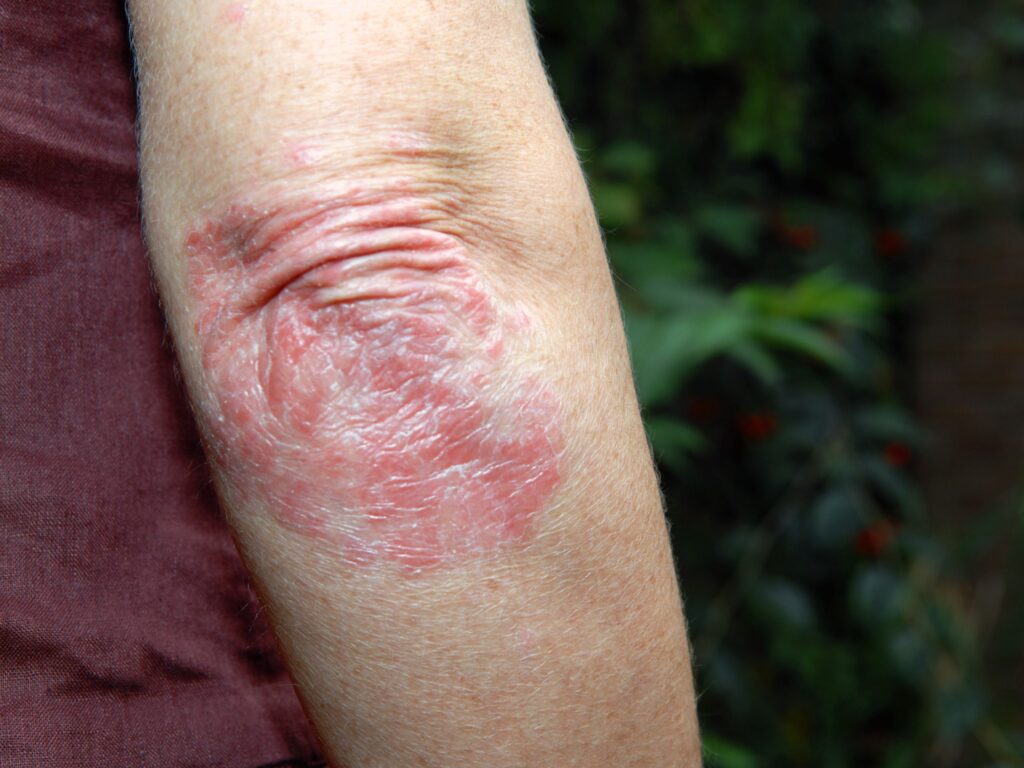 3 Psoriasis suplementos nutricionales