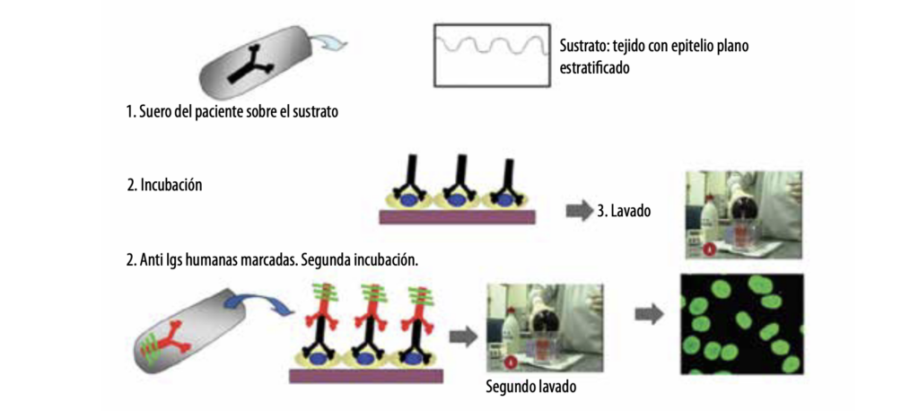 4 Enfermedades ampollares subepidérmicas autoinmunes