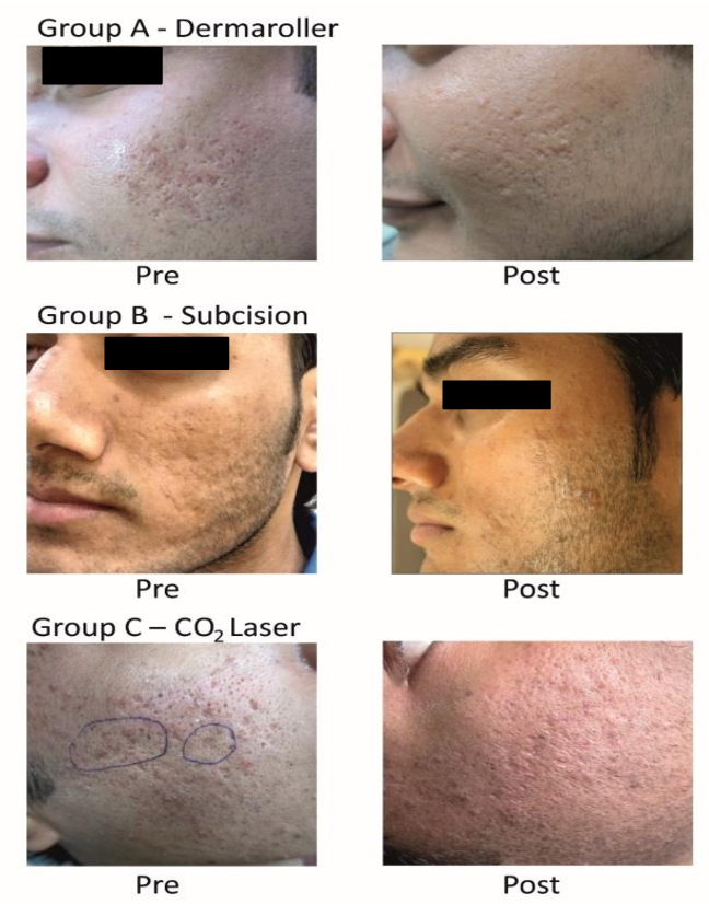5 Tratamientos cicatrices acné