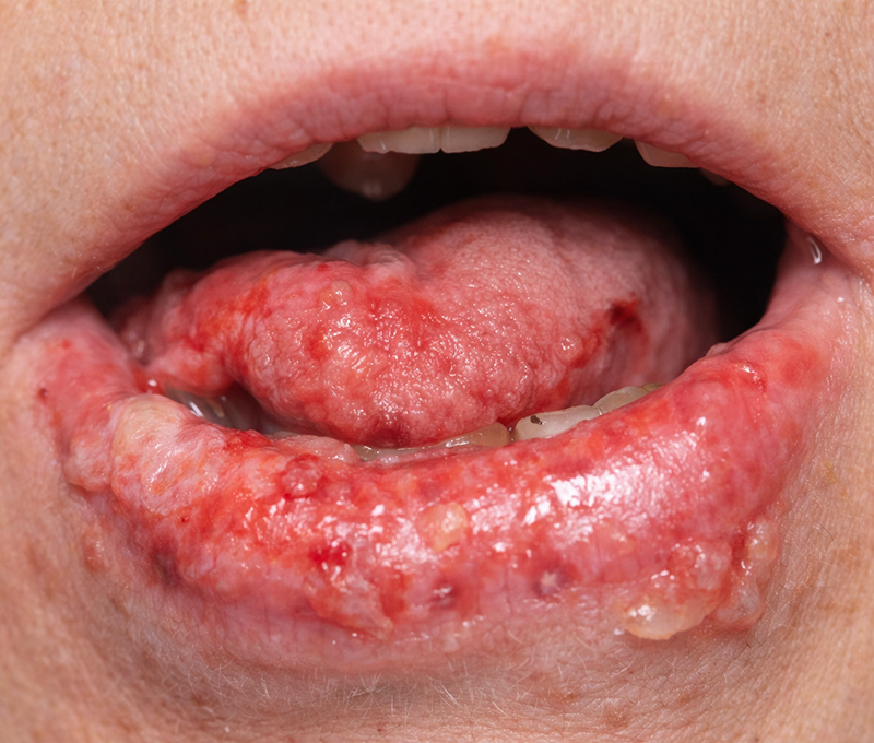 6 Autoanticuerpos enfermedades ampollares