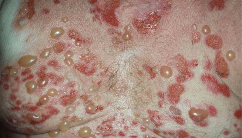 6 Diagnóstico enfermedades ampollares