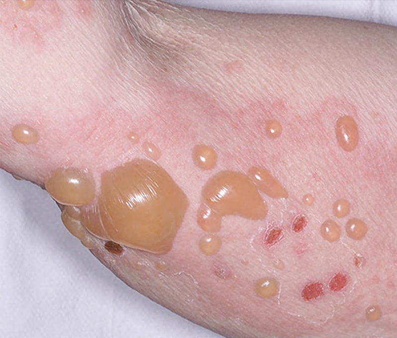 7 Autoanticuerpos enfermedades ampollares