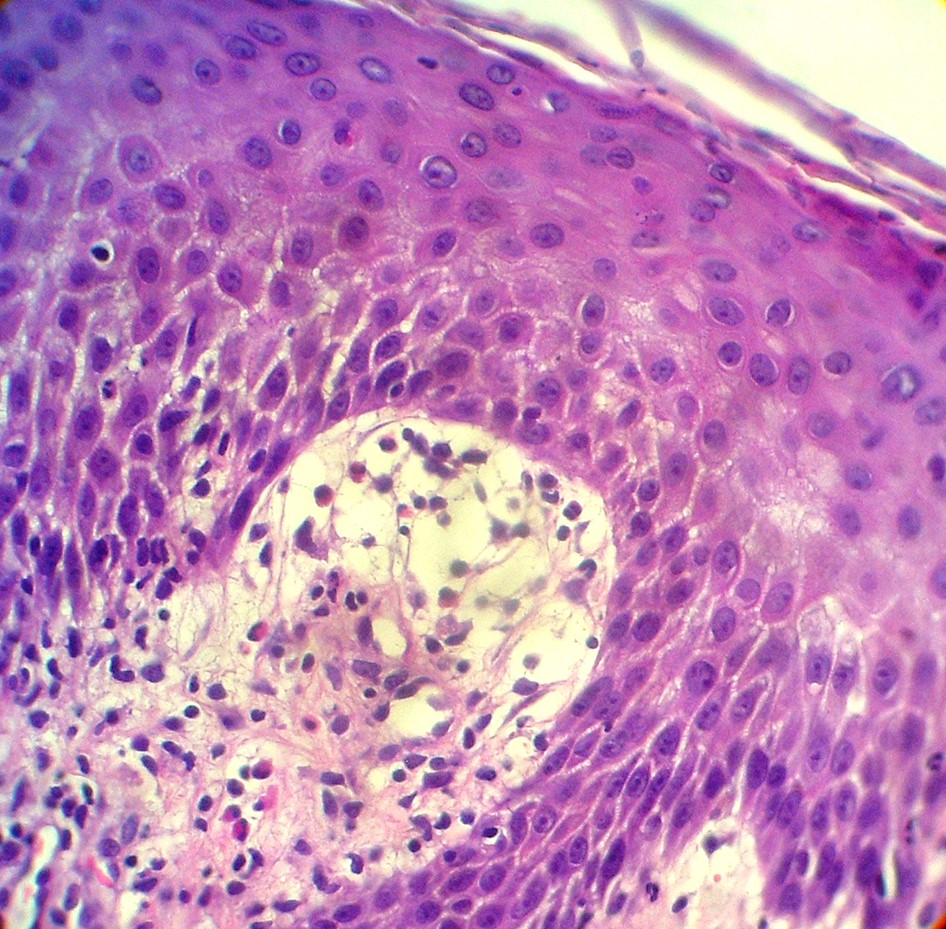 7 Enfermedades ampollares subepidérmicas autoinmunes