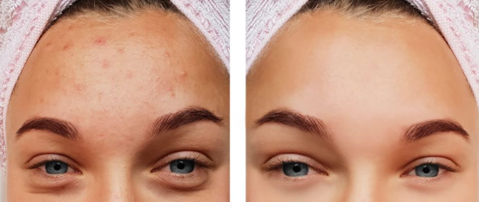 7 Tratamientos cicatrices acné