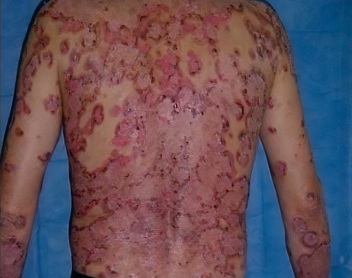 8 Diagnóstico enfermedades ampollares