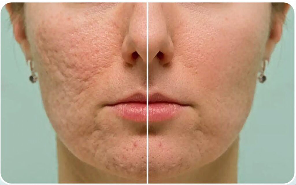 4 Tratamientos cicatrices acné