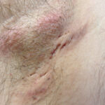0 Hidradenitis supurativa células T17 B