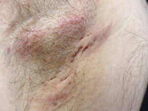 0 Hidradenitis supurativa células T17 B