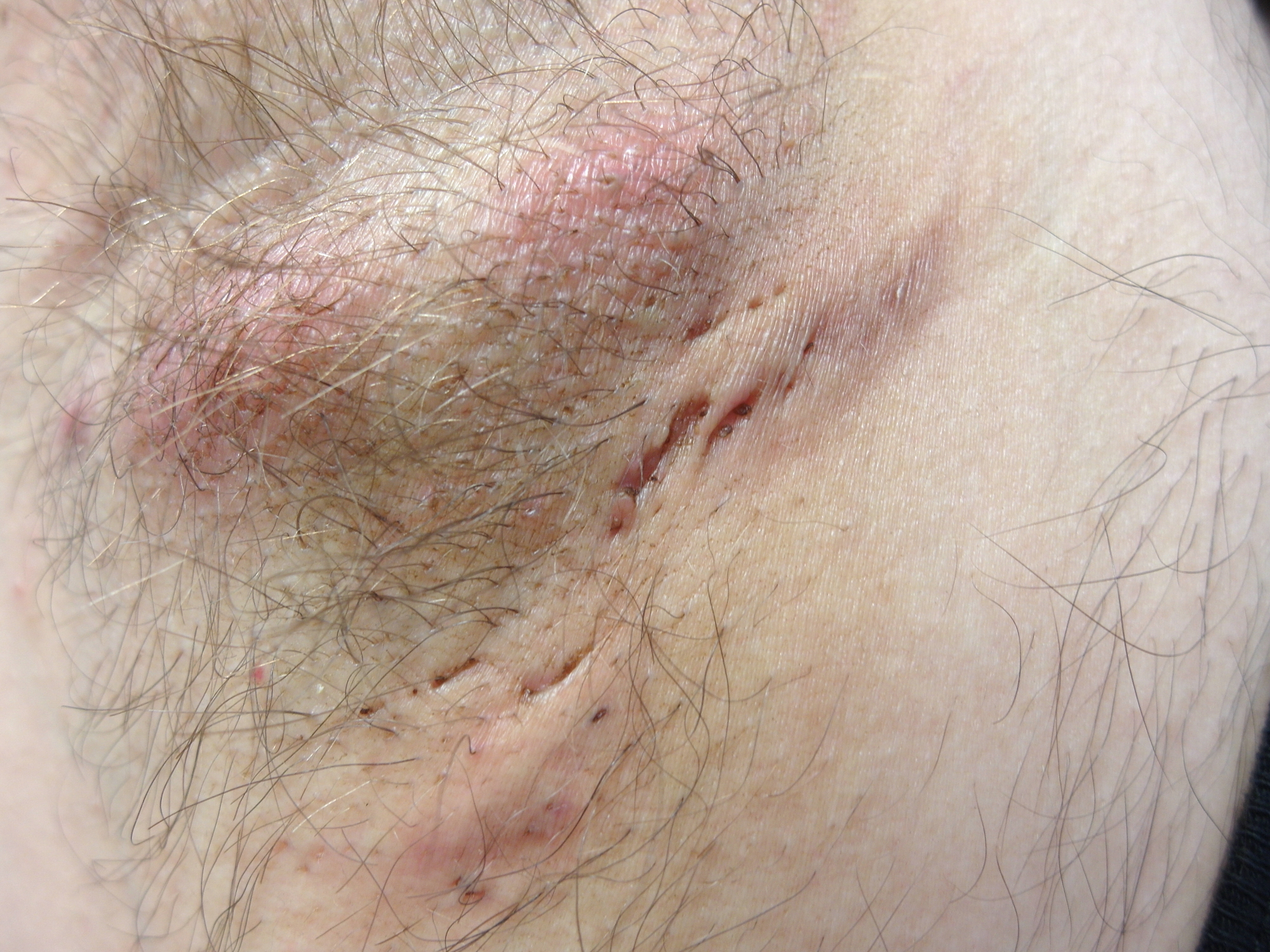 0 Hidradenitis supurativa células T17 B