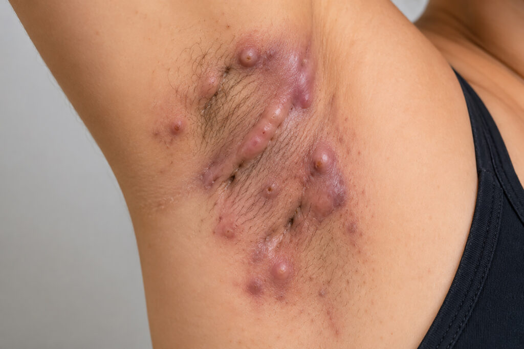 0 Hidradenitis supurativa túneles de drenaje