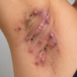 0 Hidradenitis supurativa túneles de drenaje