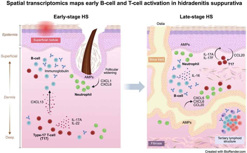 1 Hidradenitis supurativa células T17 B