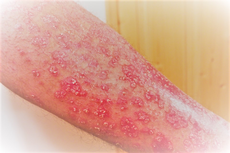 1 Psoriasis, riesgo cardiovascular y biológicos