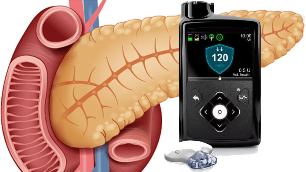 1 Tecnologías diabetes posición EASD ADA