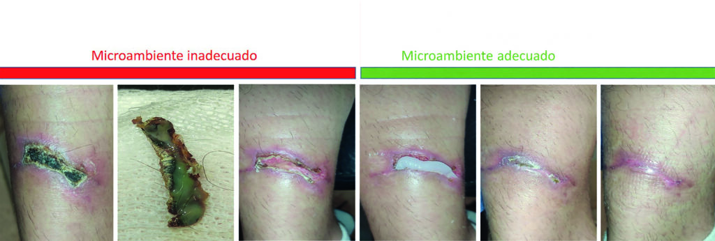 2 Desbridamiento enzimático y microambiente de la herida