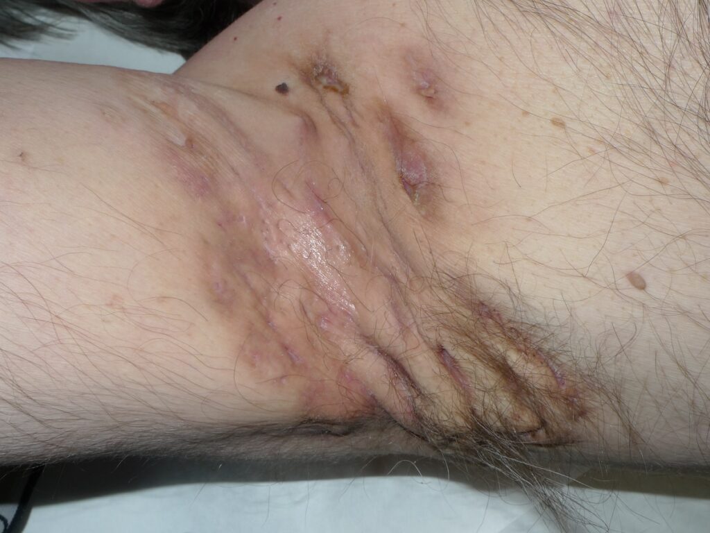 2 Hidradenitis supurativa túneles de drenaje