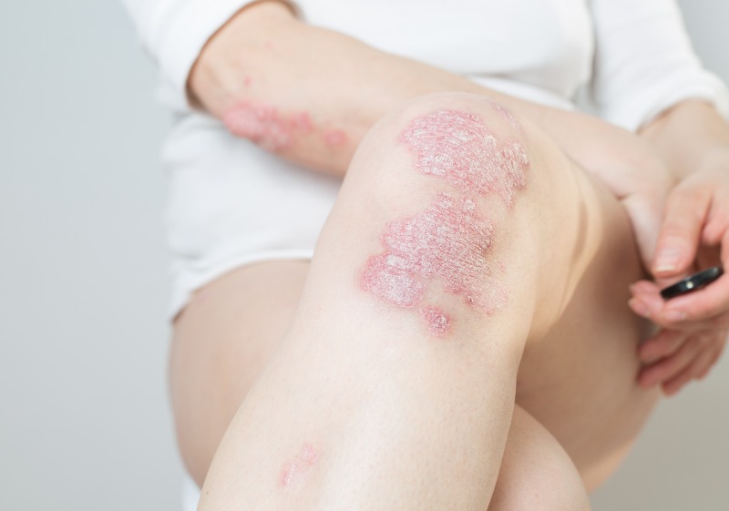 4 Psoriasis, riesgo cardiovascular y biológicos