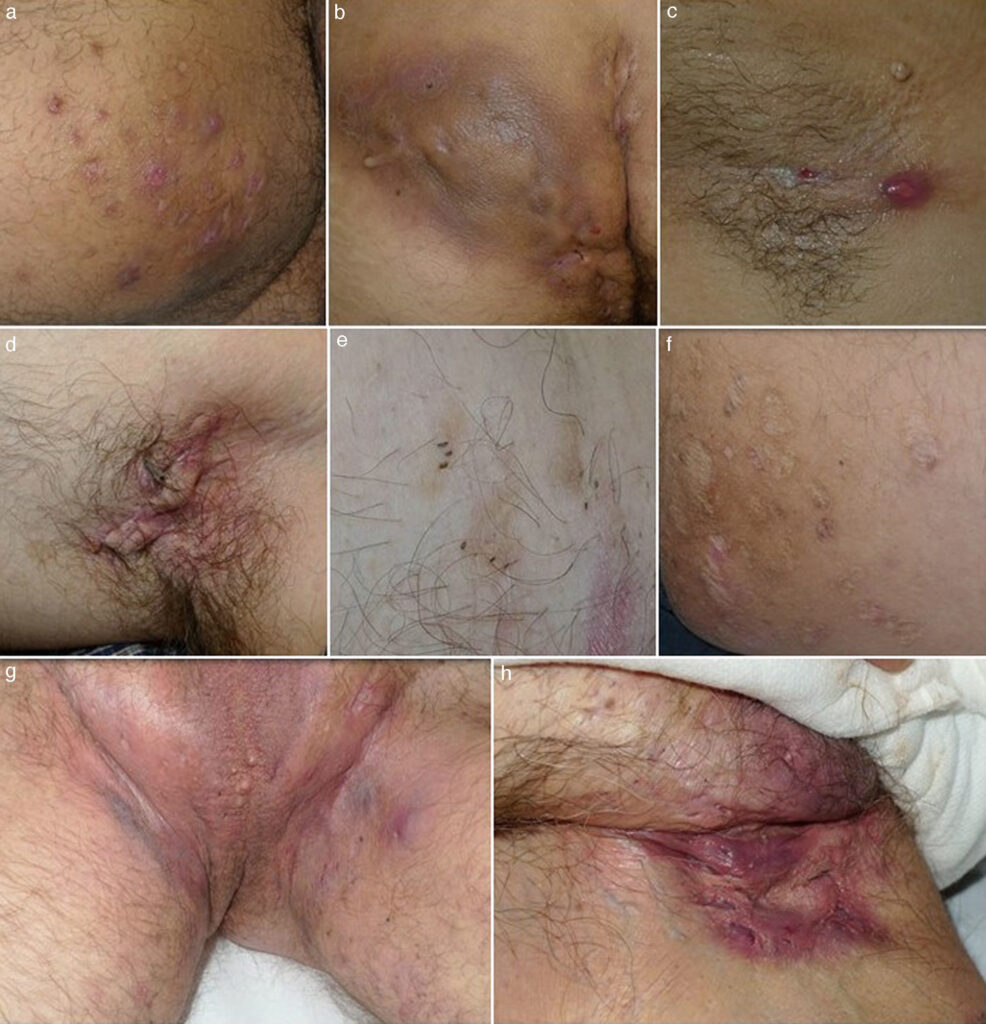 5 Hidradenitis supurativa túneles de drenaje