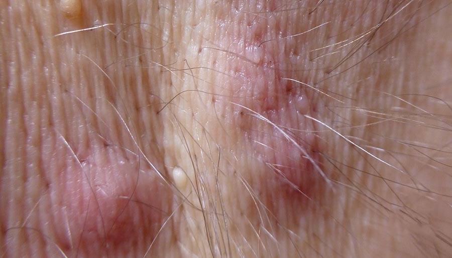 7 Hidradenitis supurativa células T17 B