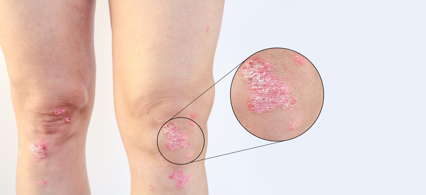 2 Psoriasis, riesgo cardiovascular y biológicos