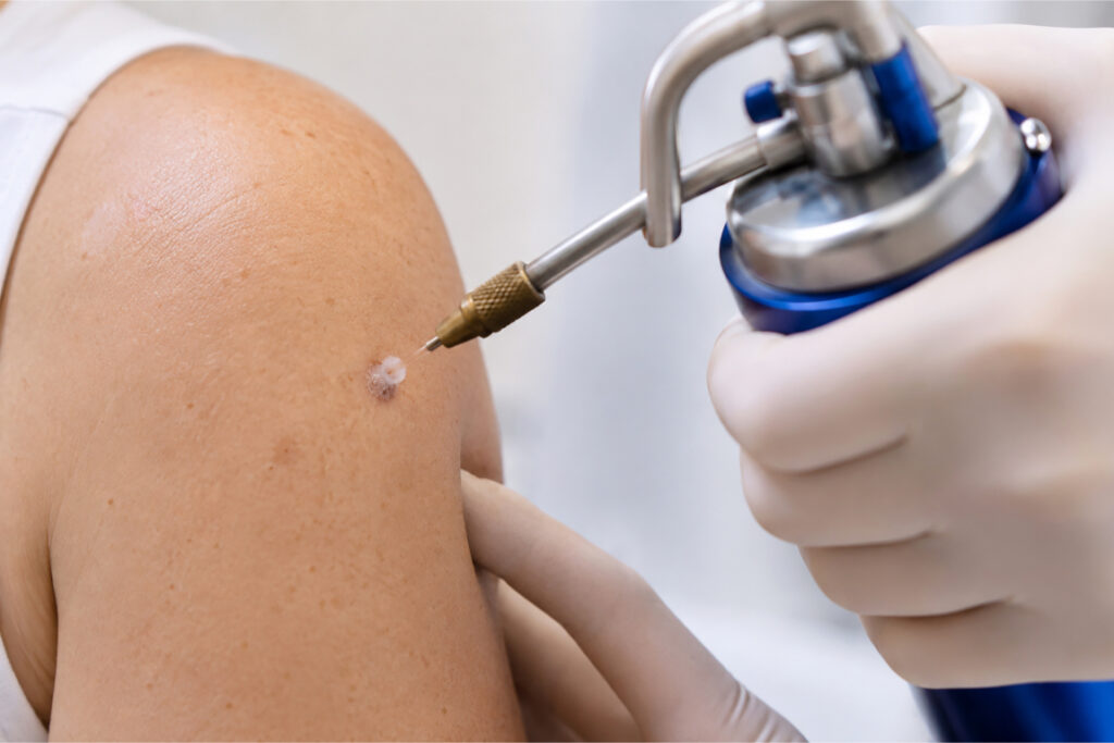 0 Crioterapia en dermatología indicaciones