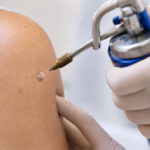 0 Crioterapia en dermatología indicaciones