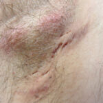 0 Hidradenitis supurativa células T17 B