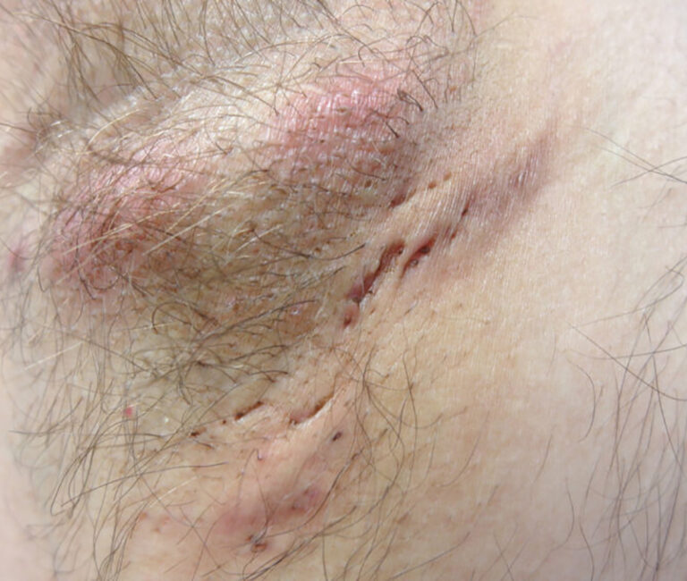 0 Hidradenitis supurativa células T17 B