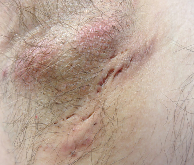 0 Hidradenitis supurativa células T17 B
