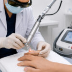 0 Nuevas tecnologías láser para psoriasis ungueal