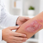 0 Psoriasis actualización europea manejo sistémico