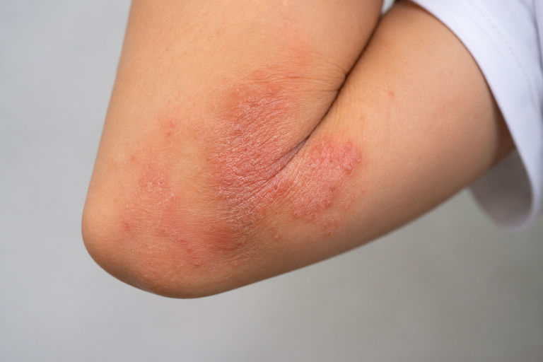 1 Dermatitis atópica expresión génica medicina de precisión
