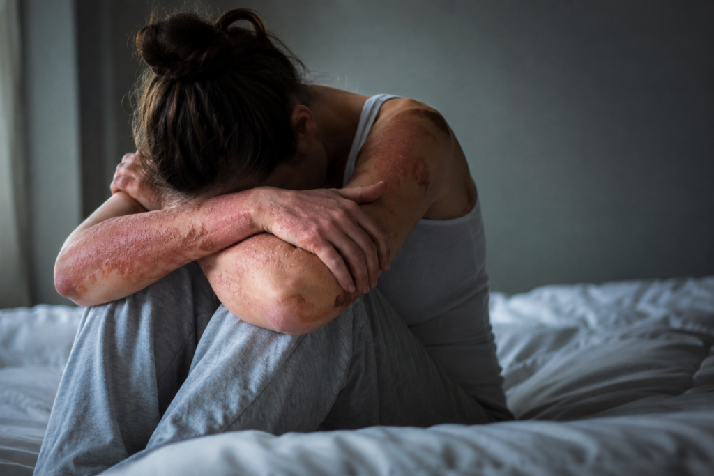 1 Dermatosis inflamatorias y salud mental
