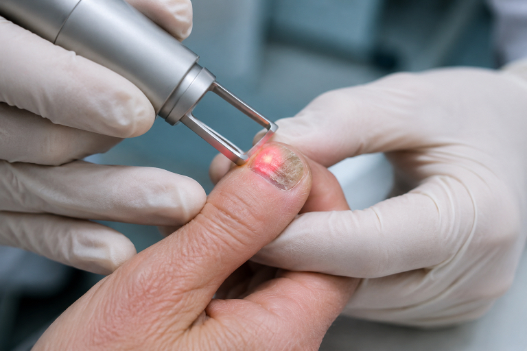 1 Nuevas tecnologías láser para psoriasis ungueal
