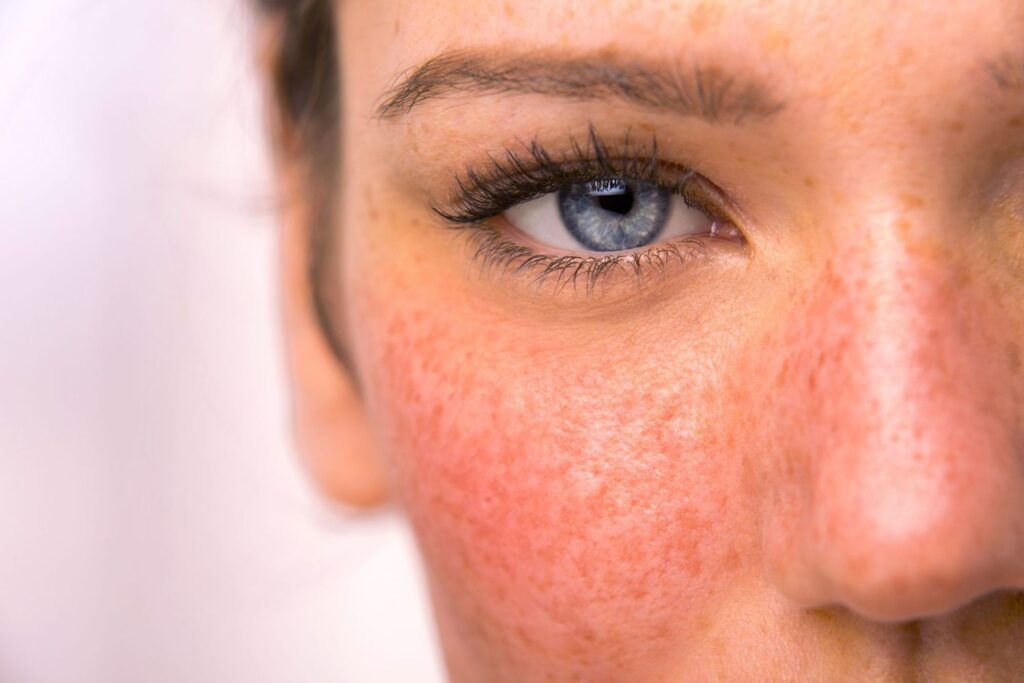 1 Rosácea biomarcadores inflamatorios y metabólicos