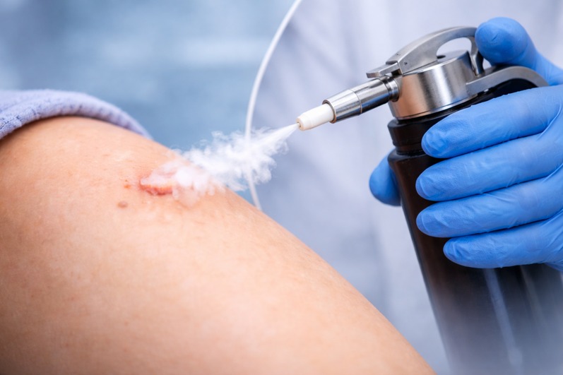 2 Crioterapia en dermatología indicaciones