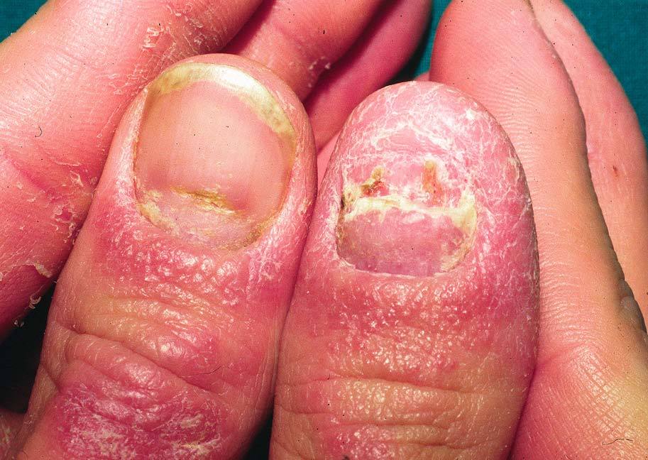 2 Nuevas tecnologías láser para psoriasis ungueal