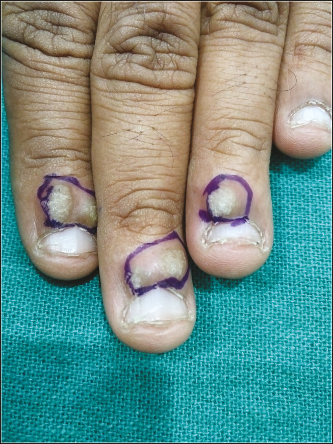 3 Crioterapia con nitrógeno líquido